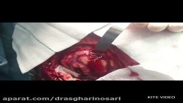 عمل جراحی اورژانس تخلیه خونریزی بسیار وسیع مغزی دکتر مسعود اصغری نوسری