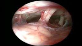 Endoscopic Vestibular Nerve Section