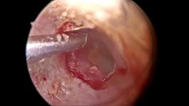 Endoscopic sealing of perilymphatic leak