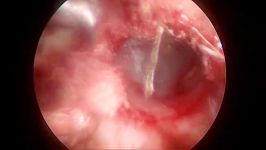 Endoscopic approach to Congenital Cholesteatoma