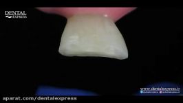 IPS Empress Direct – The material for highly esthetic fillings