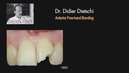 دندانپزشکی  باندینگ در دندانهای قدامی