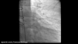 Ostial Aortic Arch Branch Stenosis