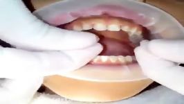 لمینیت دندانها کاملا طبیعی زیبا  02188676014
