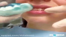 لمینیت تمام سرامیک دندان  دندانپزشکی پردیس 02188676014