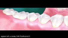 تحلیل لثه ها بر اثر عدم جرمگیری  دندانپزشکی پردیس 02188676014