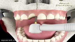 روکش دندان شکسته  کلینیک پردیس 02188676014