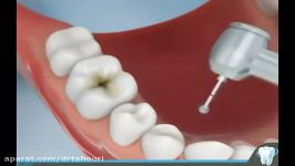 آموزش مراحل ترمیم دندان کامپوزیت  کلینیک پردیس 02188676014