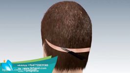 عملية زراعة الشعر في ايران  عملية زراعة الشعر في ايران
