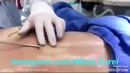 Liposuction لیپوساکشن جراحی پلاستیک