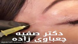 تزریق بوتاکس جهت رفع خطوط پنجه کلاغی کنار چشم  دکتر چعباوی زاده