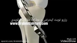 عمل تعویض لیگامان صلیبی قدامی زانو به روش اتوگرافت استفاده تاندون خود شخص 