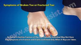 Broken Toe or Fractured Toe Treatment Symptoms Prognosis