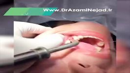 ایمپلنت دندان توسط بهترین دندانپزشک غرب تهران
