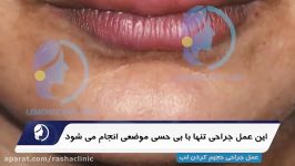 جراحی حجیم سازی لبها توسط تیم مجرب جراحی سر گردن لیمون