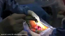 جراحی اصلاح زانوی پرانتزی به صورت کم تهاجمی