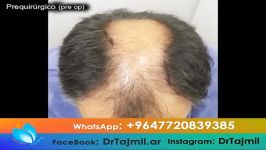 تجربتی عملیة زراعة الشعر فی ایران