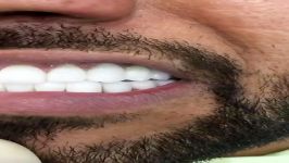 Hollywood Smile 