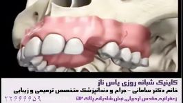 Dental Implant ایمپلنت یا کاشت دندان