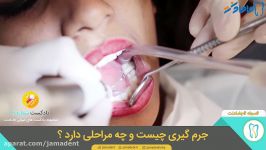 جرمگیری دندان ، مفید است یا مضر ؟