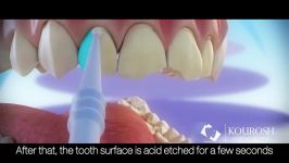فیلم مراحل انجام لمینت دندان  کلینیک دندانپزشکی کوروش