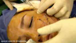 5 آموزش تکنیکهای ابداعی لیفت کنگره متخصصین پوست ایران
