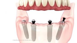 فیلم کاشت دندان بر پایه ایمپلنت  ایمپلنت دندان مشهد