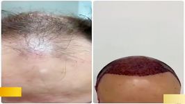 نتائج زراعة الشعر فی ایران دكتور تجمیل