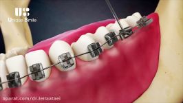 تحلیل ریشه دندان  دکتر لیلا عطایی