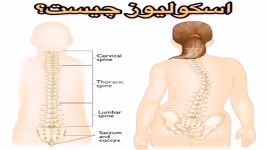 درمان اسکولیوزیس بریس،فیزیوتراپی09122655648ویزیت در مطب،منزل،کاردرمانی