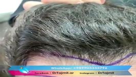تكلفة زراعة الشعر في ايران مشهد