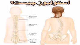 درمان پزشکی اسکولیوزیس بریس،فیزیوتراپی09122655648ویزیت در مطب،منزل تهران