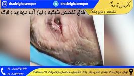 فوق تخصص شبکیه  جراح چشم تهران  عمل لازک