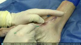 Dr. Benjamin Overley  Deltoid Ligament Repair Using TruShot™ with Y Knot