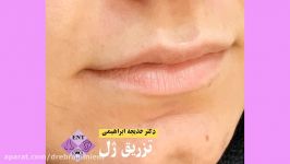 برجسته سازی فرم دهی طبیعی لب تزریق ژل