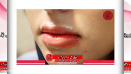 تزریق ژل  فیلم تزریق ژل  کلینیک پوست مو رز  شماره 18