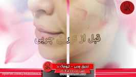 تزریق چربی  فیلم تزریق چربی  کلینیک پوست مو رز  شماره24