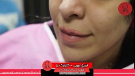 تزریق چربی  فیلم تزریق چربی  کلینیک پوست مو رز  شماره26