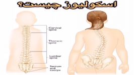 درمان اسکولیوز مرکز فیزیوتراپی09122655648شمال تهران.الهیه،زعفرانیه،ولنجک