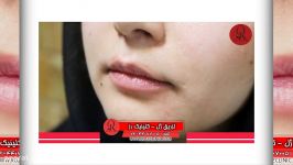 تزریق ژل  فیلم تزریق ژل  کلینیک پوست مو رز  شماره 19