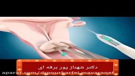 کلیپ گذاشتن IUD