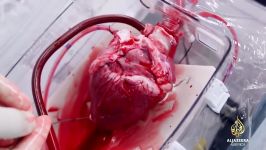 انتقال قلب درحال ضربان برای کاشت در سینه بیمار