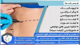 لیفت سینه ماموپلاستی  09122167875