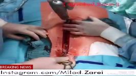 Open heart surgery . جراحی باز قلب