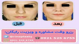 عمل زیبایی بینی دکتر امیر حسین محمدی مفرد09215256755