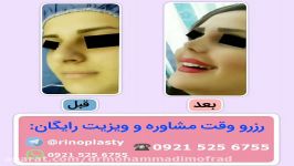 عمل زیبایی بینی دکتر امیر حسین محمدی مفرد09215256755