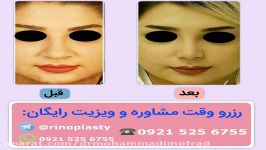 عمل زیبایی بینی دکتر امیر حسین محمدی مفرد09215256755