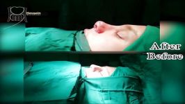 قبل بعد جراحی بینی توسط جراح بینی شیراز