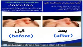 عمل زیبایی بینی دکتر امیر حسین محمدی مفرد09215256755