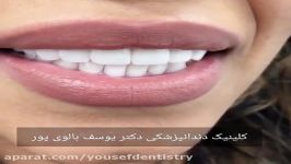 ونییر کامپوزیت  لامینیت دندان اصلاح طرح لبخند در مطب دکتر یوسف بالوی پور